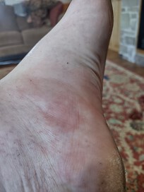 Deep itching red hive on arch of foot. 